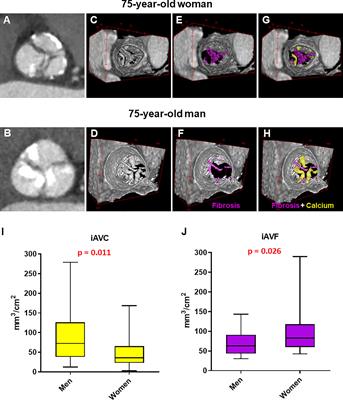 Sex-Specific Cell Types and Molecular Pathways Indicate Fibro-Calcific Aortic Valve Stenosis